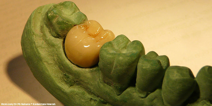 Как мне распечатали зубную коронку на 3D-принтере